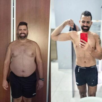 Antes e Depois Cirurgia Bariátrica 1