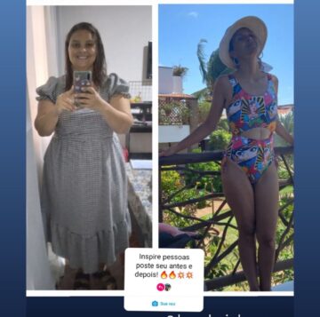 Antes e depois cirurgia bariátrica 5